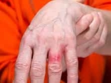 提防金属过敏导致接触性皮炎夏季佩戴首饰须谨慎